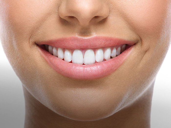 Porcelain Veneers at miami cosmetic smile design