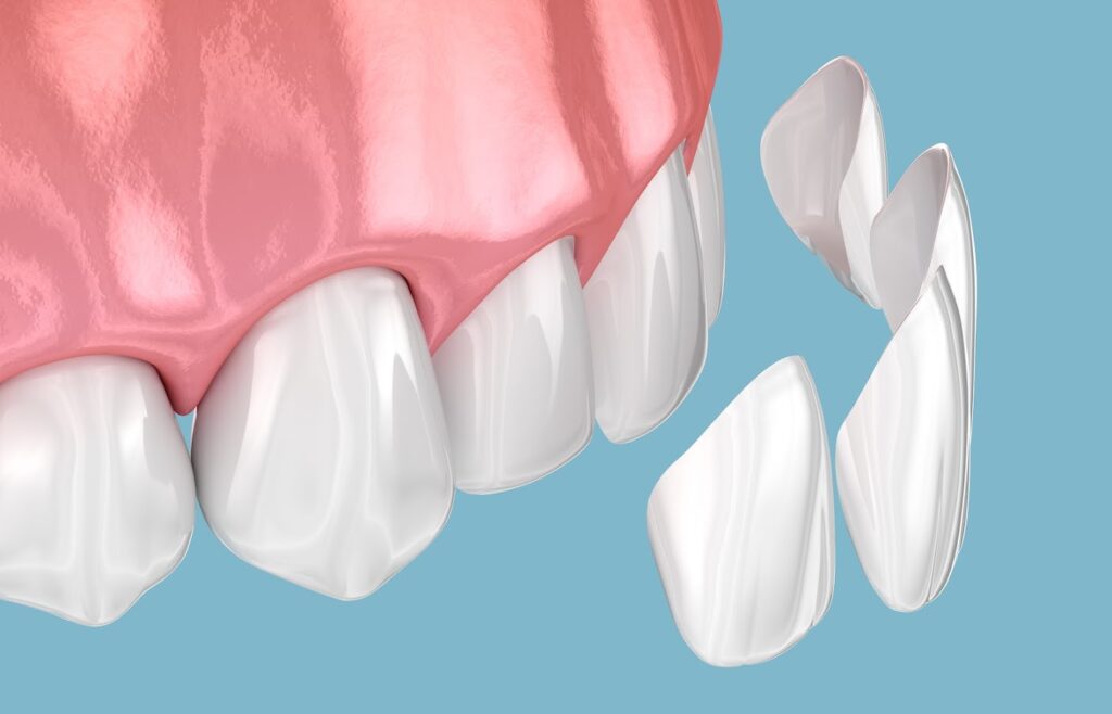 An illustration of veneers