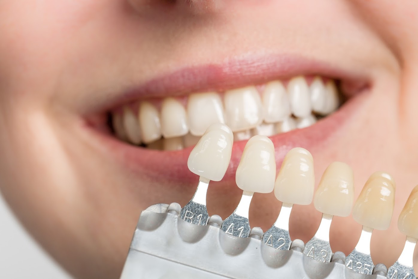 Different shades of veneers in front of a woman's mouth