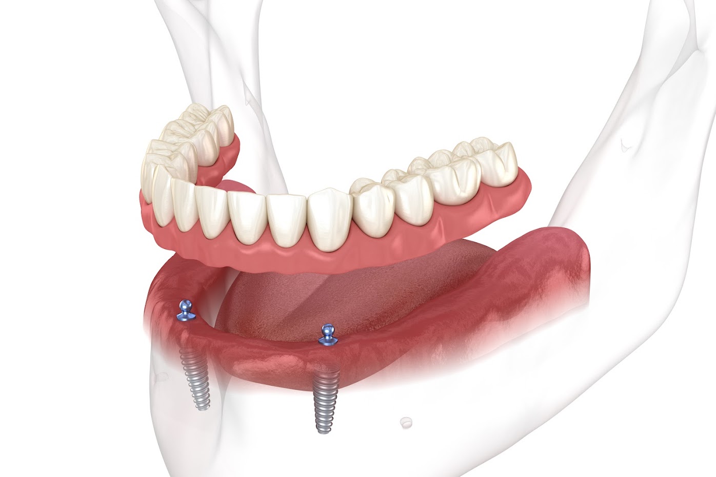 Removable prosthesis on the lower jaw