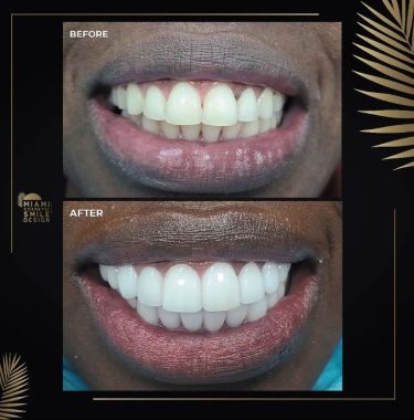 Miami-Cosmetic-Smile-Design-01.jpg