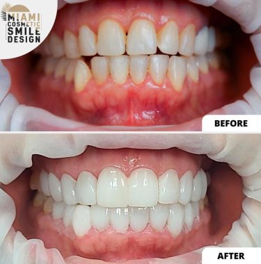 Miami-Cosmetic-Smile-Design-02.jpg
