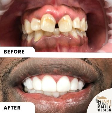 Miami-Cosmetic-Smile-Design-03.jpg