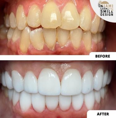 Miami-Cosmetic-Smile-Design-04.jpg