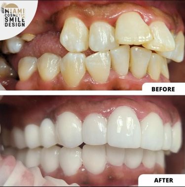 Miami-Cosmetic-Smile-Design-05.jpg