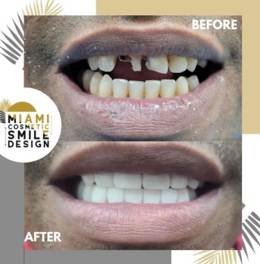 Miami-Cosmetic-Smile-Design-06.jpg