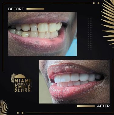 Miami-Cosmetic-Smile-Design-08.jpg